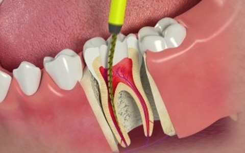 Endodontia